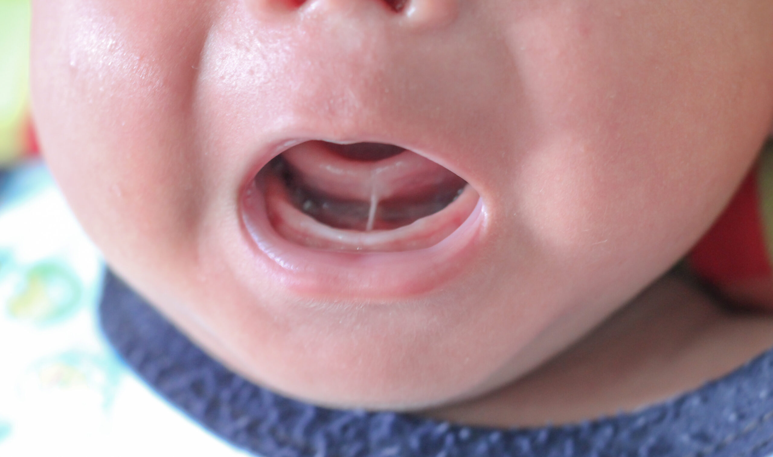 Tongue tie patient. A baby opens its mouth and reveals its frenulum.